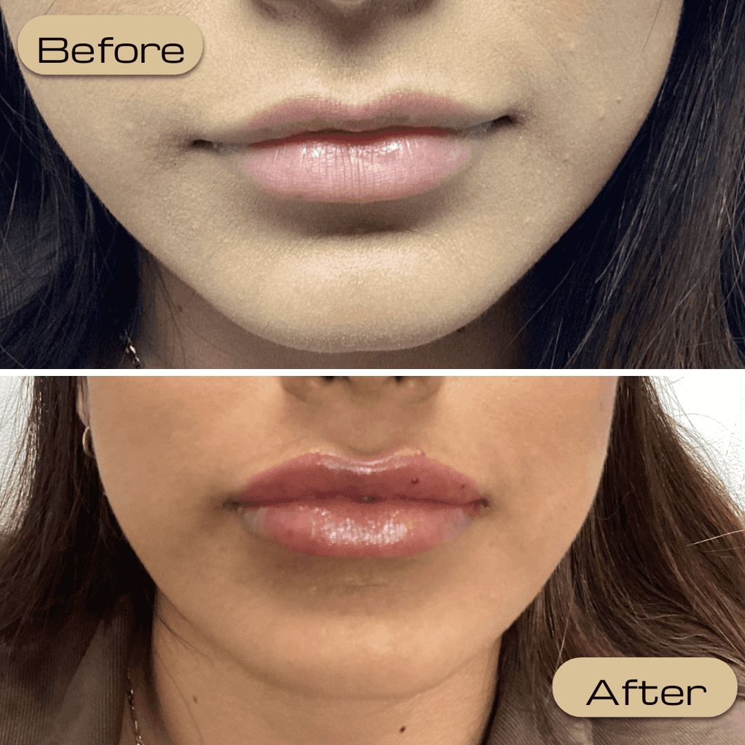 Perfect Pouts in San Diego Your Guide to Lip Filler Options