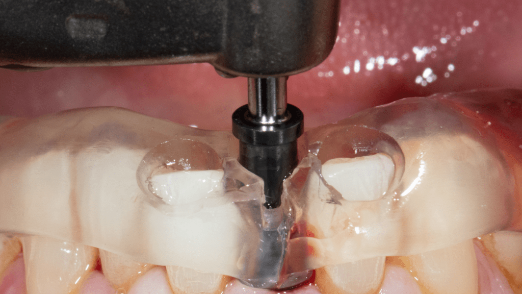 Guided Surgery How do we ensure your dental implants are right where