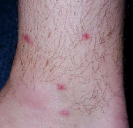 How To Get Rid Of Sand Fleas How I Get Rid Of