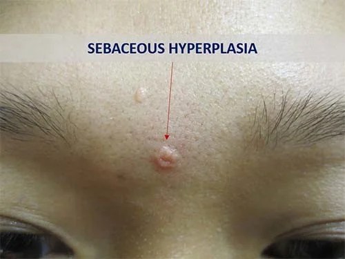 Get Rid of Sebaceous Hyperplasia HowRid 19568