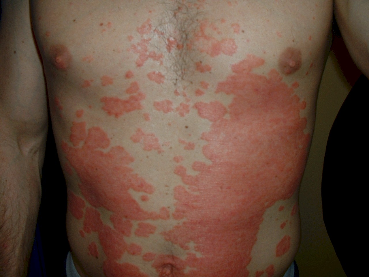 How To Beat Psoriasis Psoriasis F.A.Qs Psoriasis Care