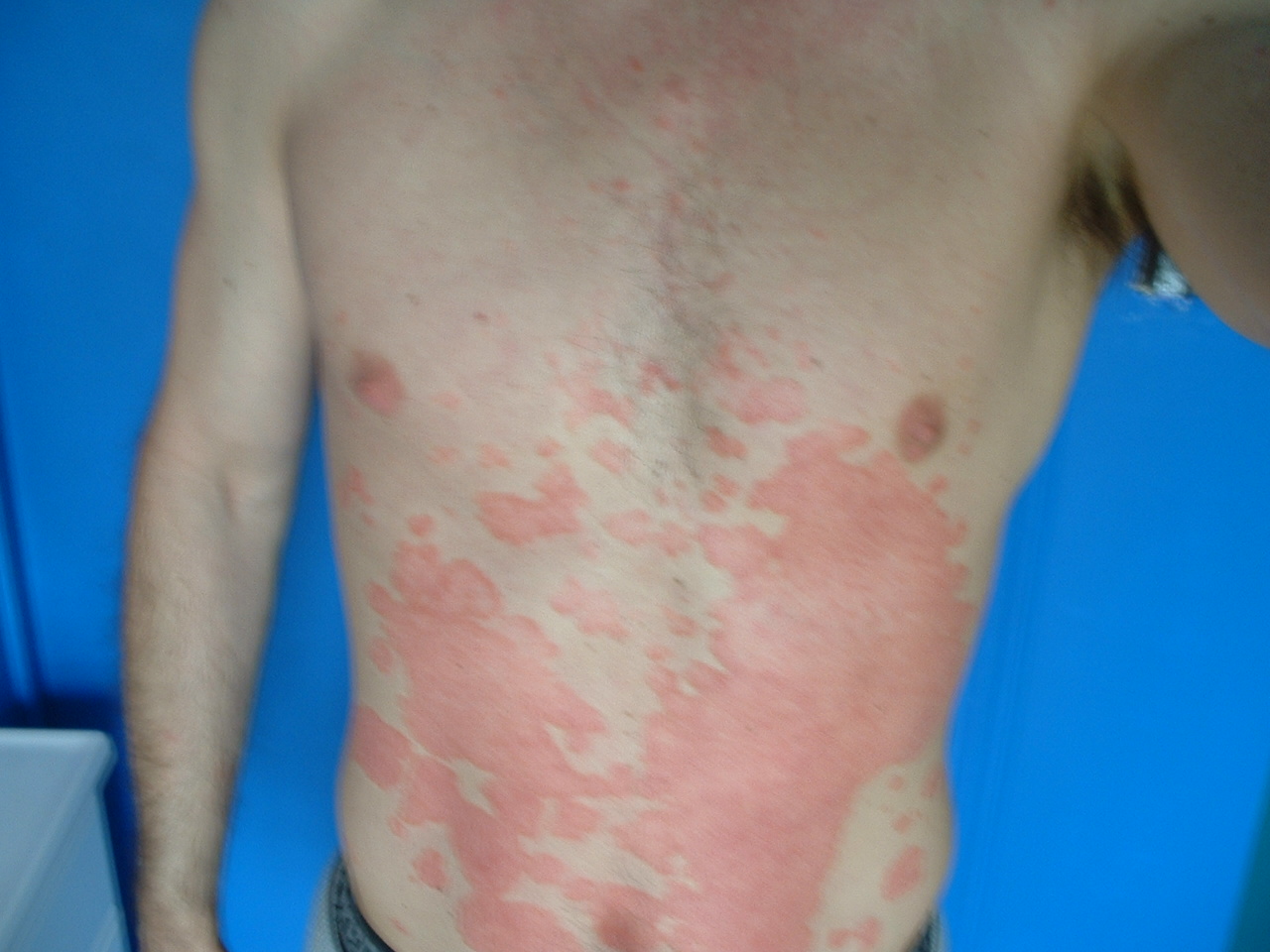 How I beat psoriasis WDDTY