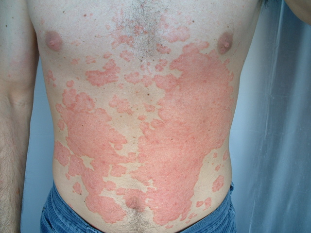 How I Beat Psoriasis PatientsEngage