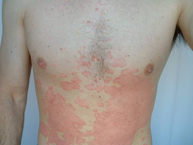 Psoriasis Treatments: How To Get Rid of Psoriasis WebMD
