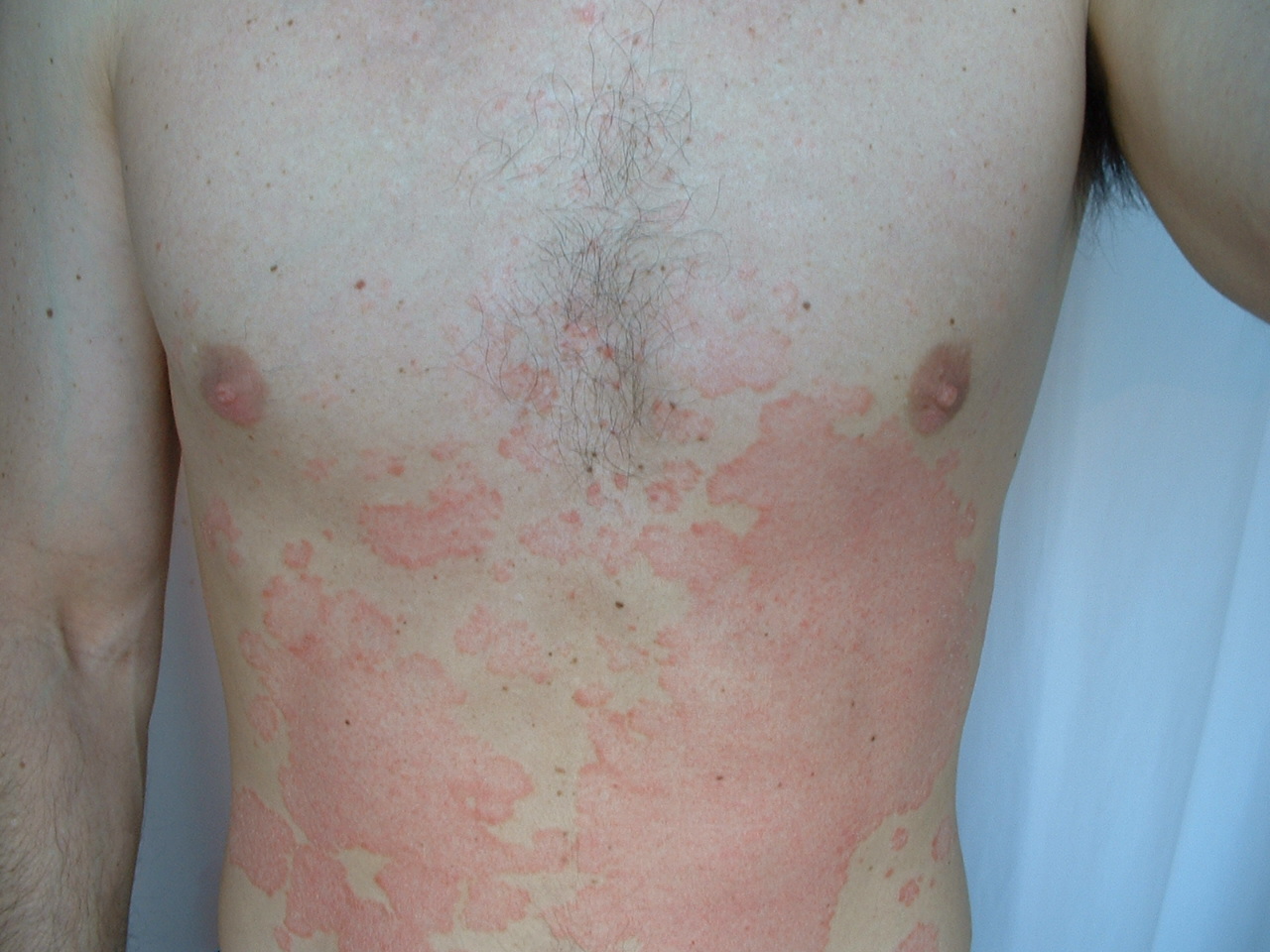 16 Natural Ways To Beat Psoriasis Prevention