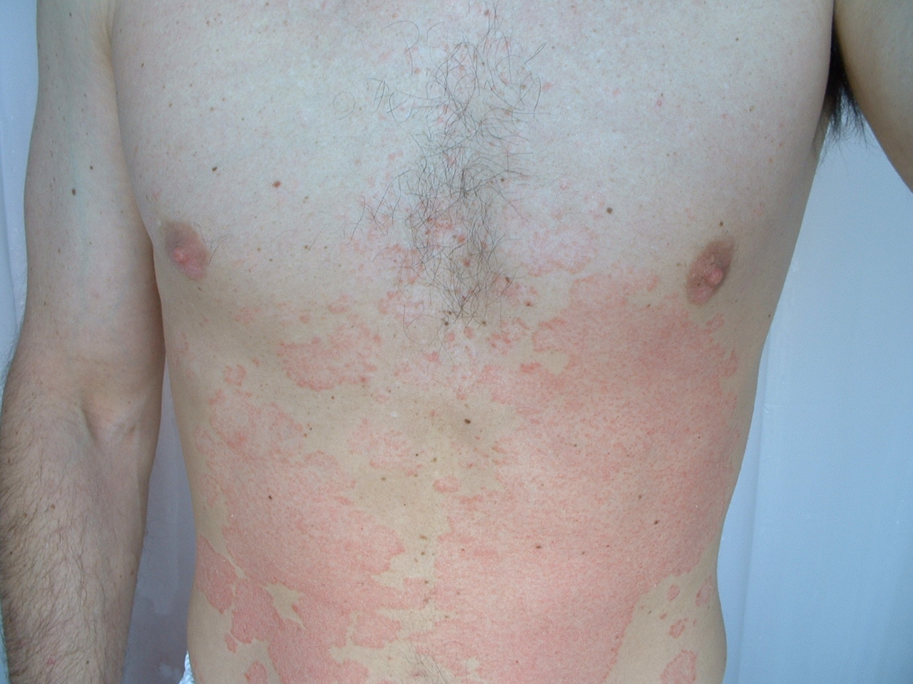 Psoriasis Diet: Foods to Eat and Avoid If You Have Psoriasis