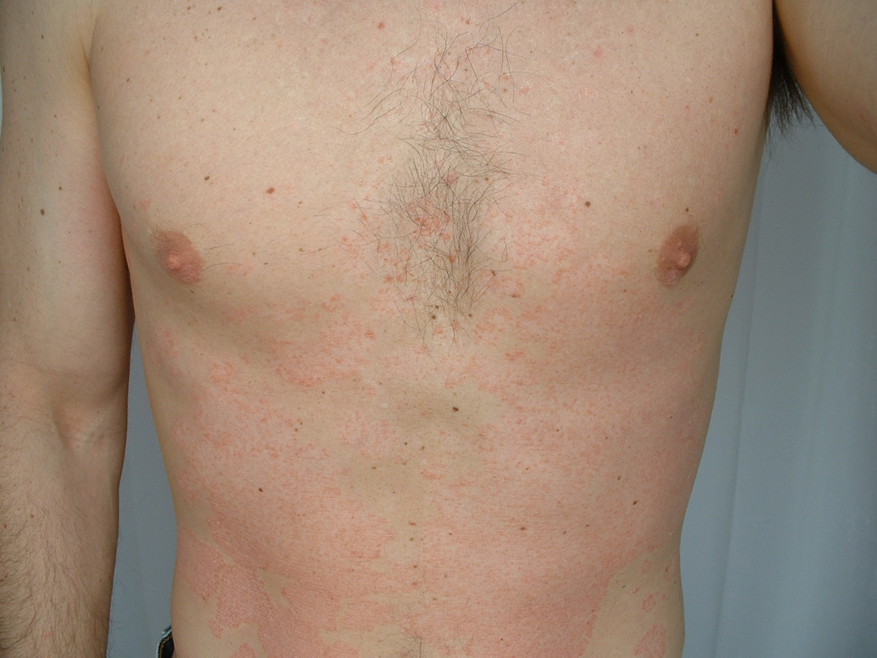 Psoriasis: 12 home remedies and how to avoid triggers