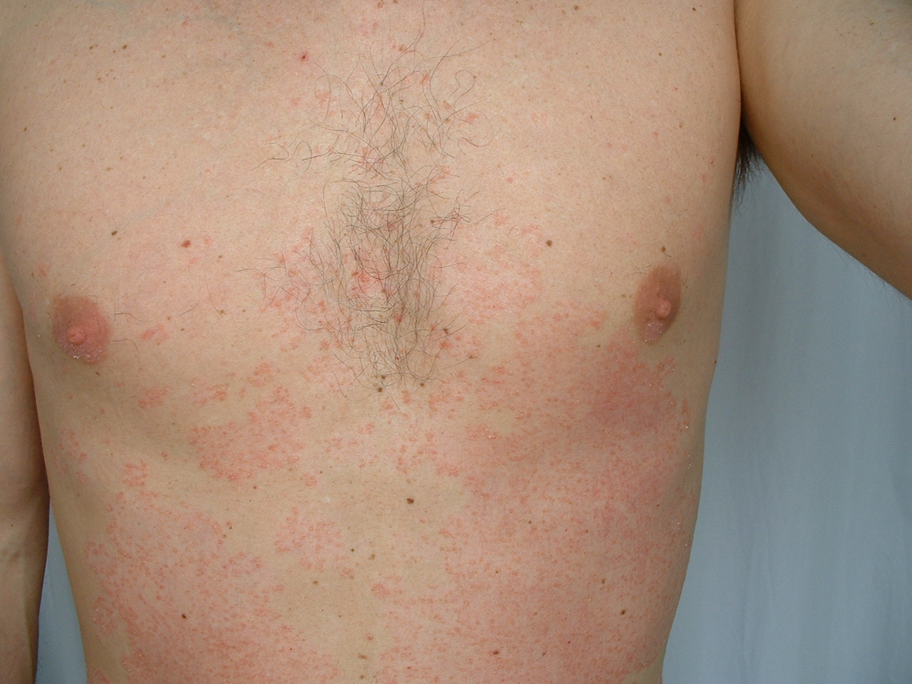 4 Ways to Treat Psoriasis Naturally wikiHow