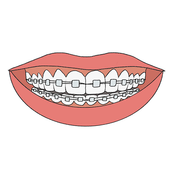 How to Draw Braces Easy Drawing Tutorial For Kids