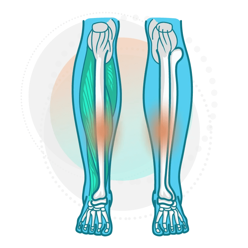 How to fix Shin Splints Treat your Shin Splints Right the First Time