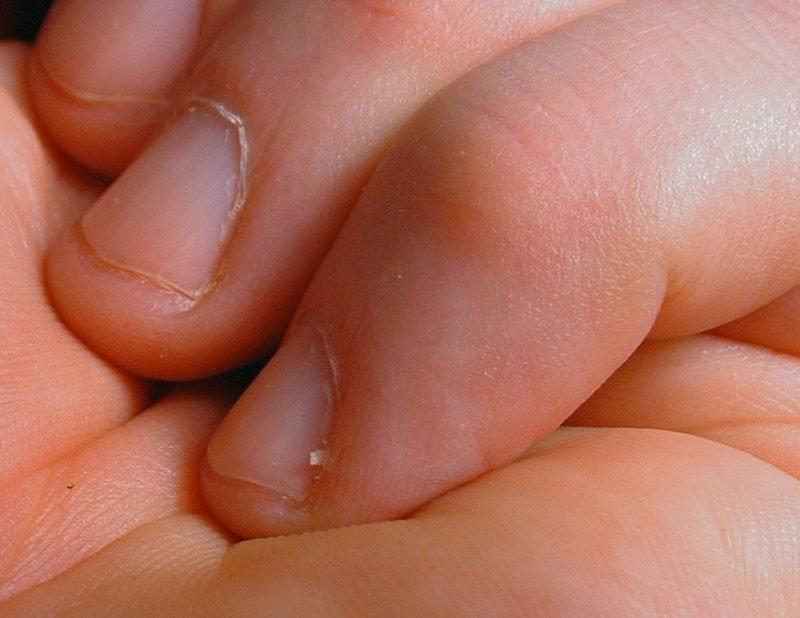 How to Get Rid of Hangnails and Ways To Heal Them (Updated 2019)