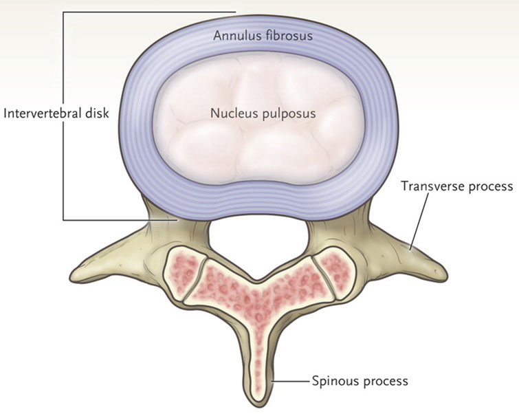 Homeopathy for Slipped Disk