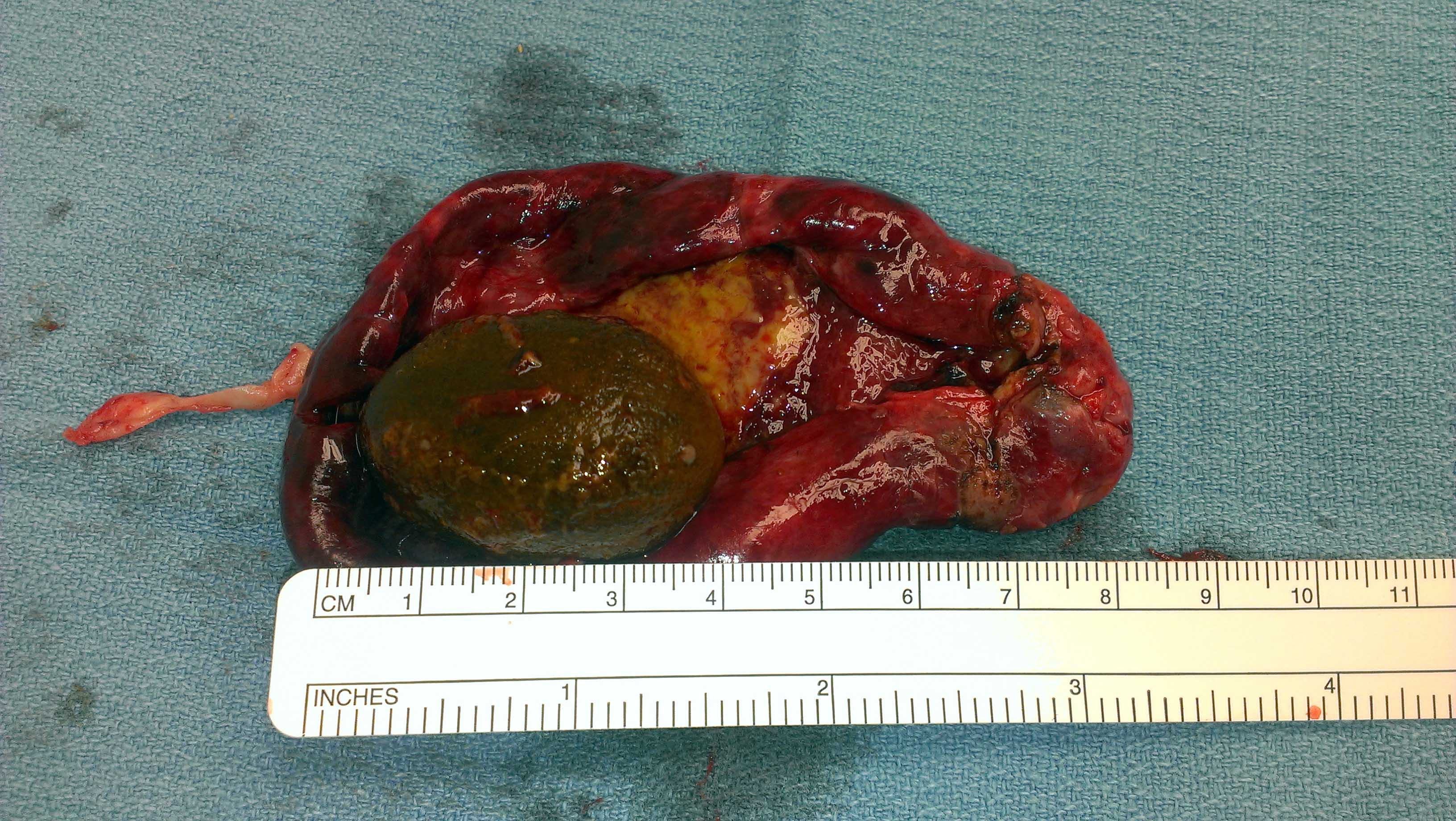 Low Cost Gallbladder surgery FORSYTH SURGICAL