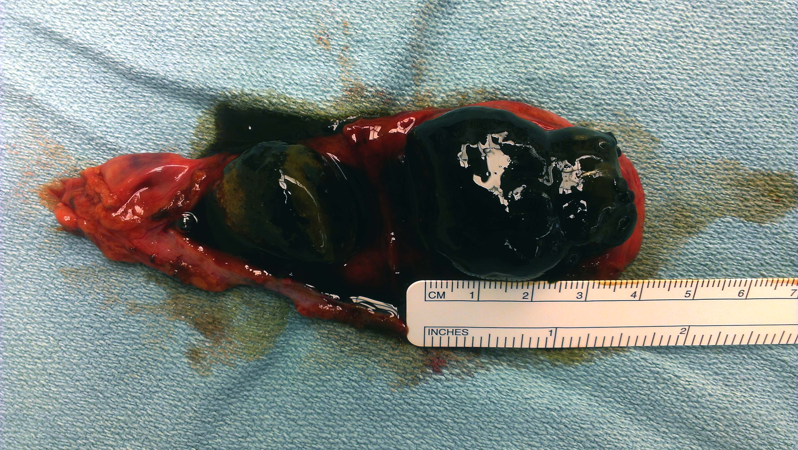 Low Cost Gallbladder surgery FORSYTH SURGICAL