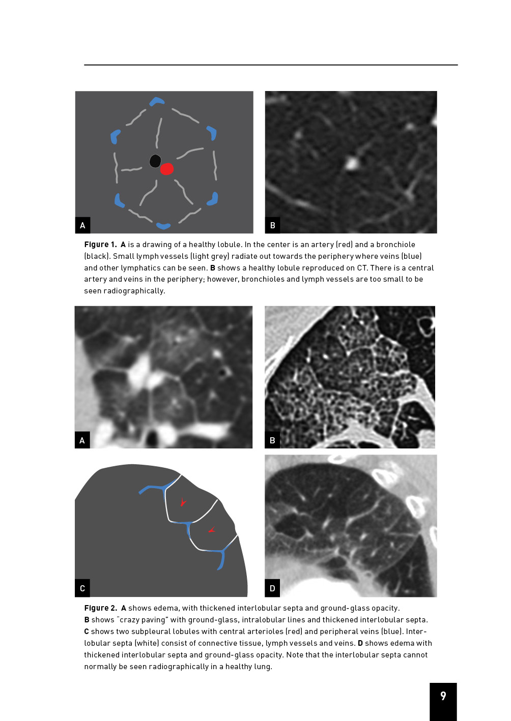 HRCT Pattern Recognition and Differential Diagnosis of Lung Disease