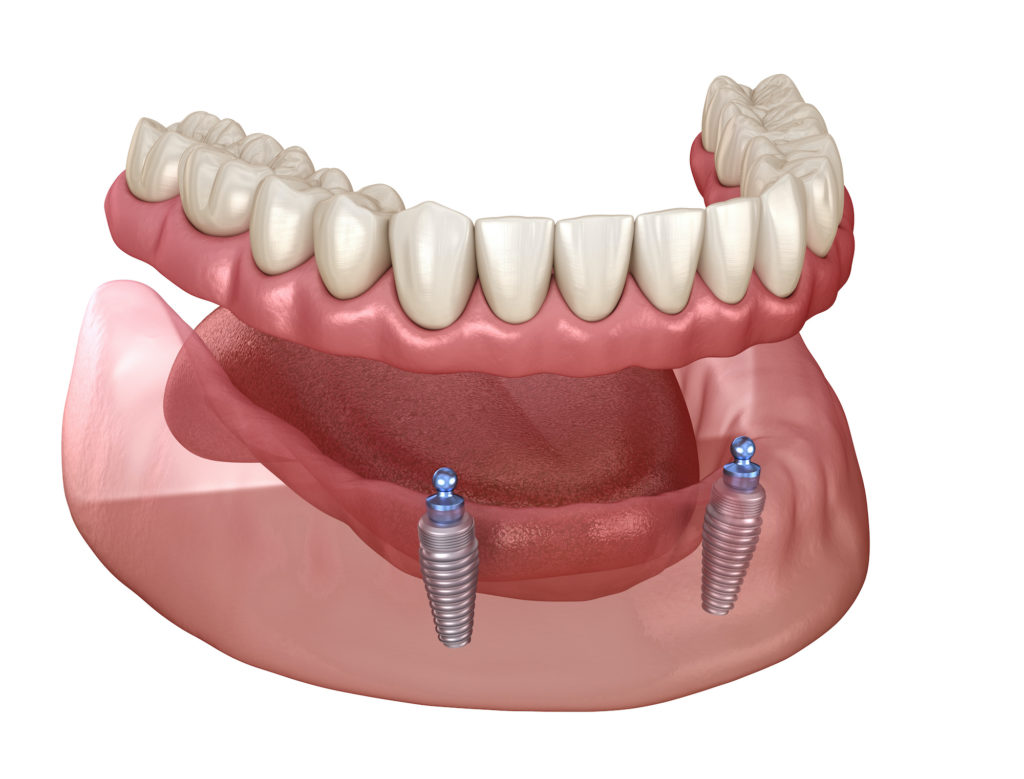 Implant Retained Dentures Lethbridge Dentist