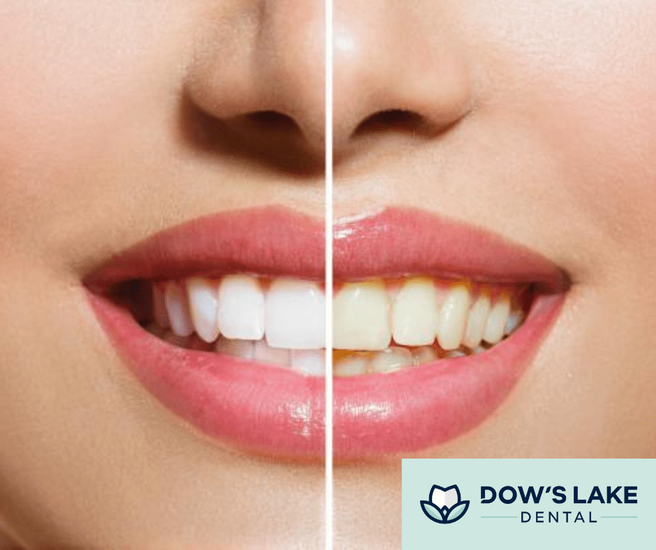 All About Tooth Discolouration Dow's Lake Dental in Ottawa, ON