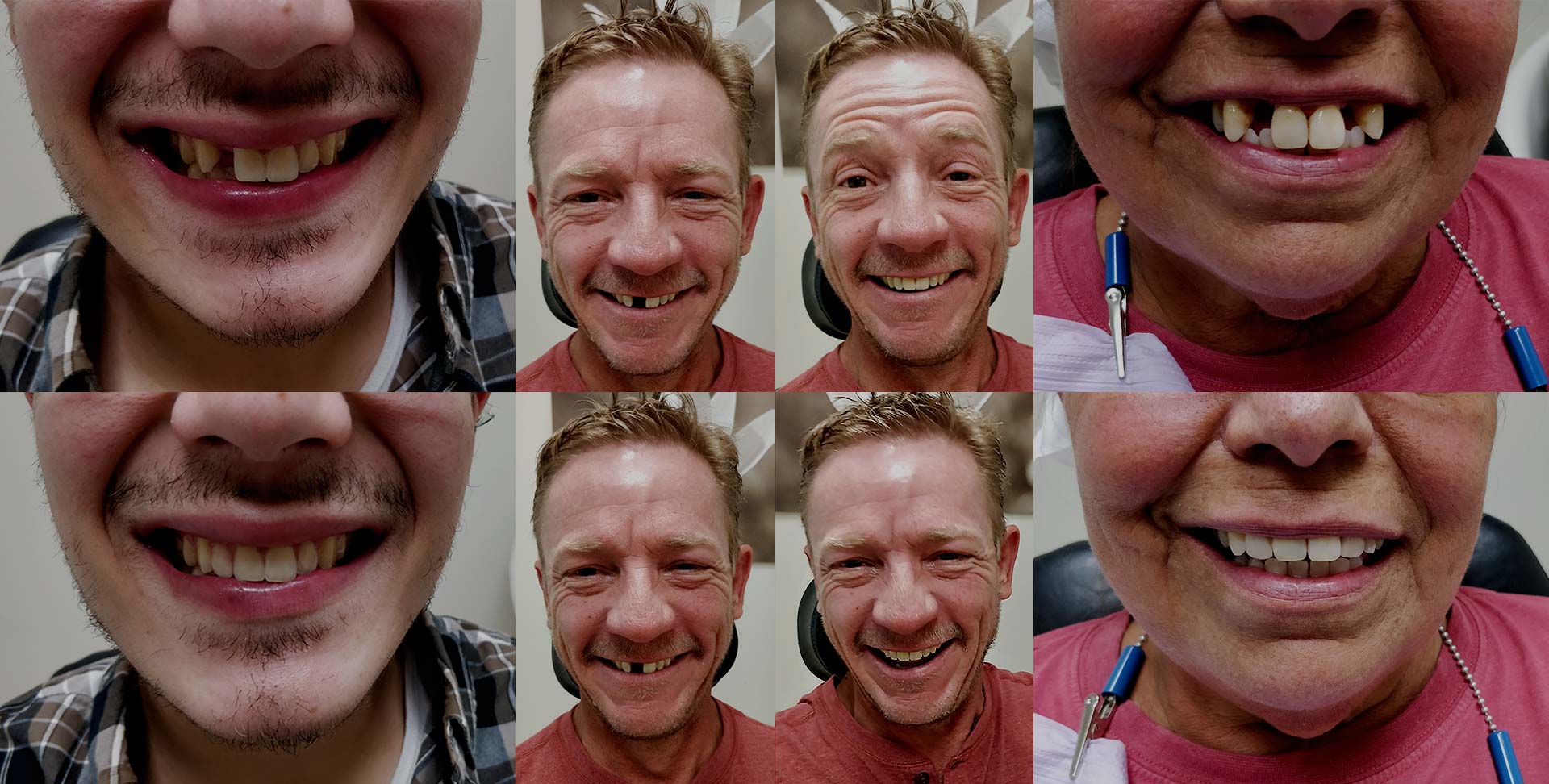 Dental Flippers Hayven Dentures St. Catherines