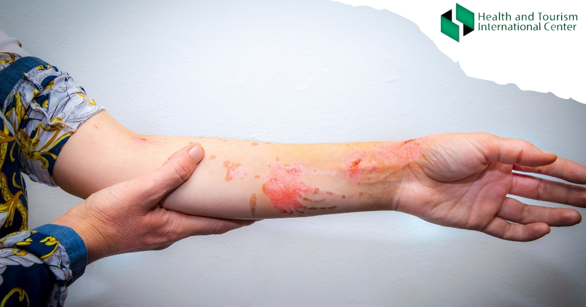 Burns When to see a doctor? HTI CENTERS Medical Tourism Center