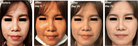 Improvement of Atrophic Acne Scar and Skin Complexity by Combination of