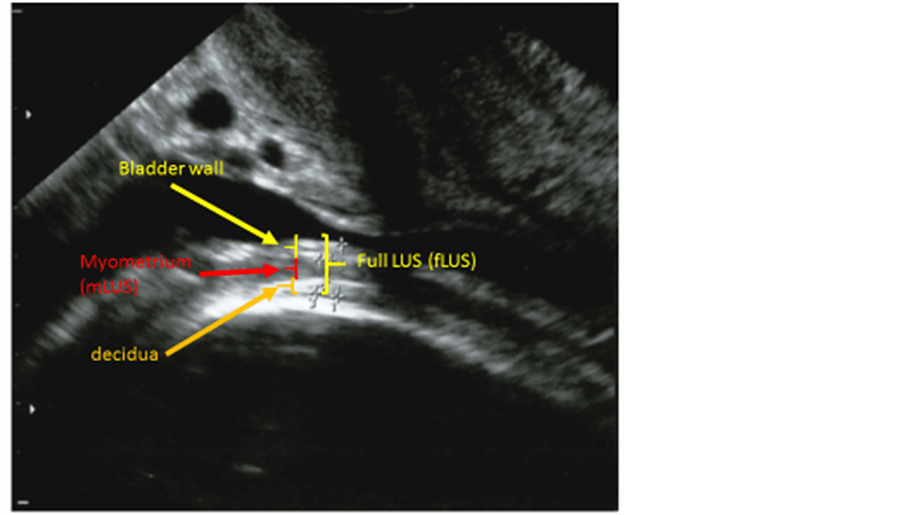Measurements of the Lower Uterine Segment at Term in Women with