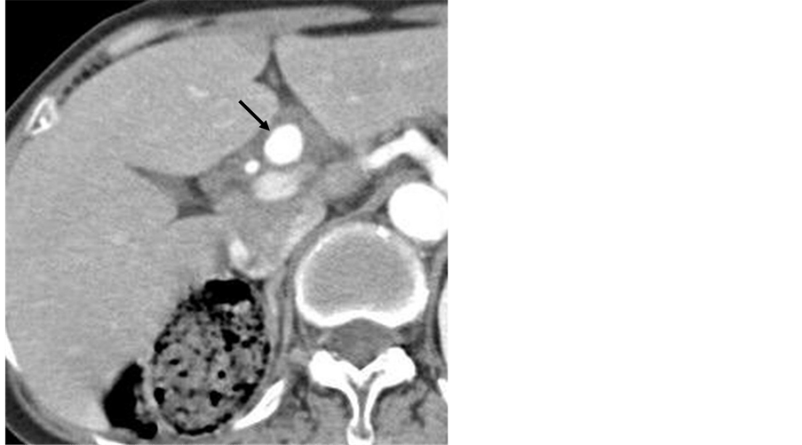 Effectiveness of Endovascular Coil Embolization of Ruptured Hepatic Artery Pseudoaneurysm