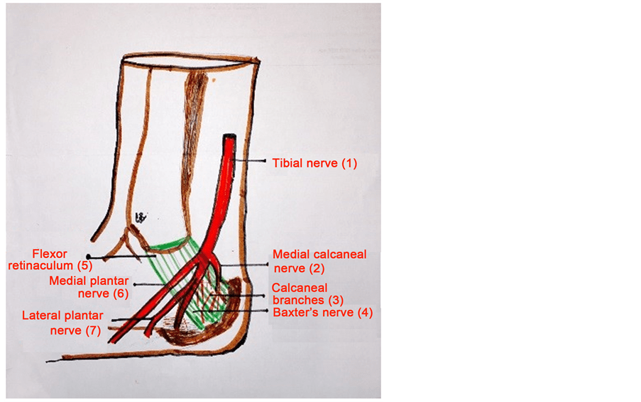 Tarsal Tunnel Syndrome—A New Way to Diagnose an Old Problem