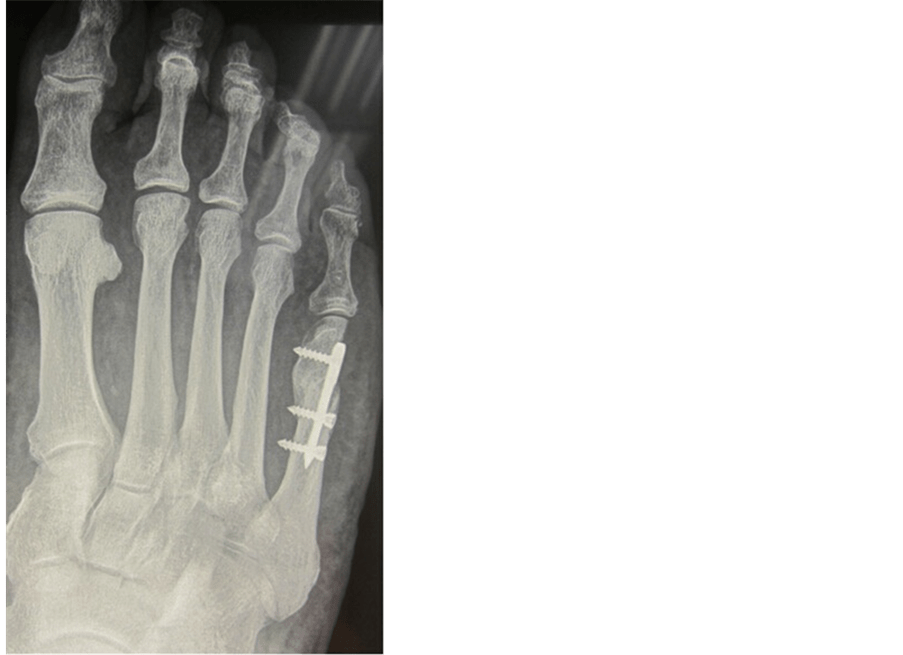 A New Intramedulary Locking Plate for the Osteotomy of the V. Metatarsal in the Correction of