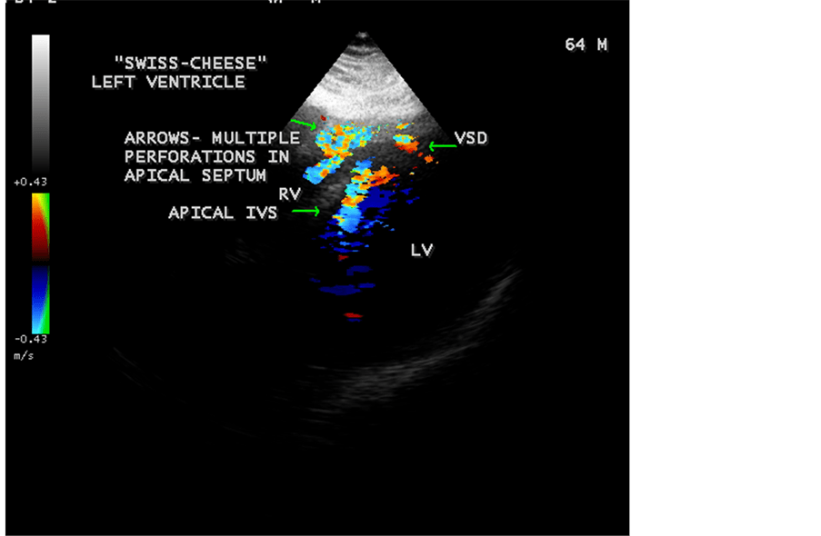 “SwissCheese” Left Ventricle in Acute Myocardial Infarction—A Case Report
