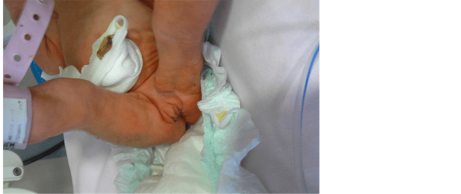 Trisomy 18 A Difficult Decision for the Family