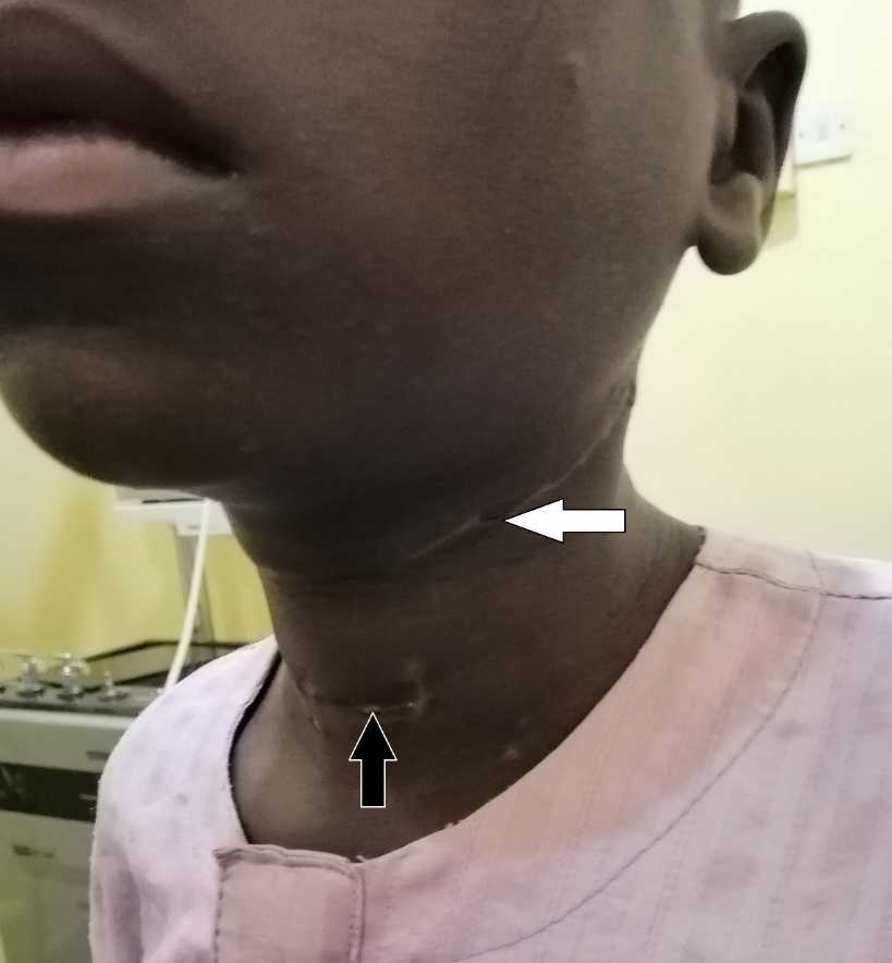 Severe Cut Throat Injury in a Child A Case Report and Review of Literature