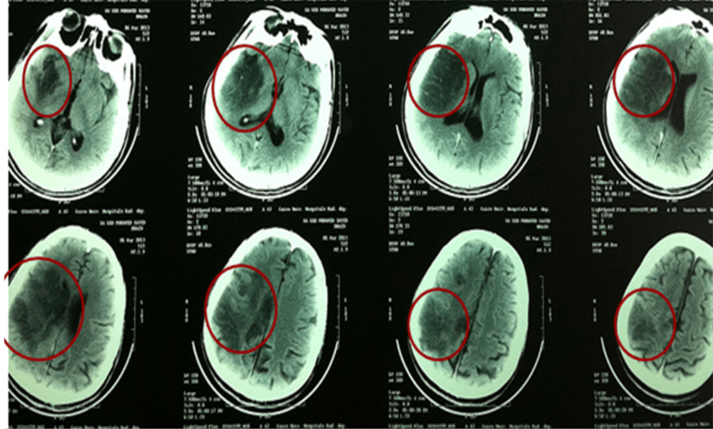 Multiple Major ThromboEmbolic Events, including Stroke, in a Patient