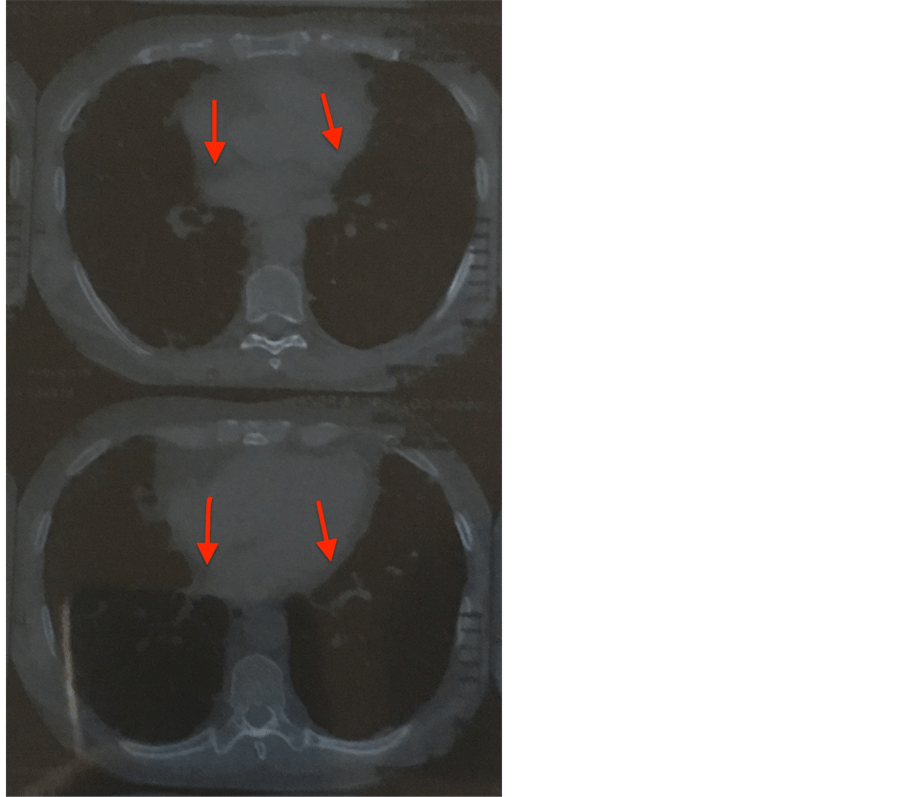 Pulmonary Fibrosis Due to Nitrofurantoin Therapy A Case Report