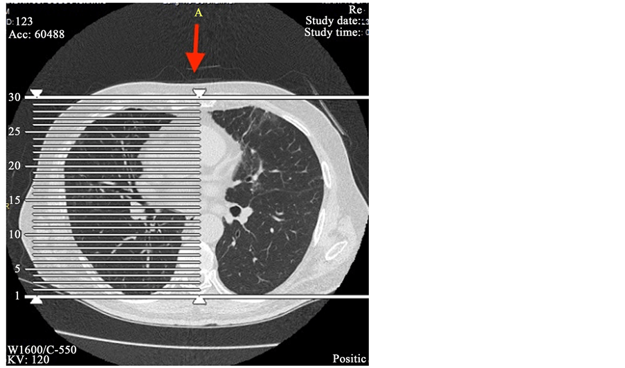 Pulmonary Fibrosis Due to Nitrofurantoin Therapy A Case Report