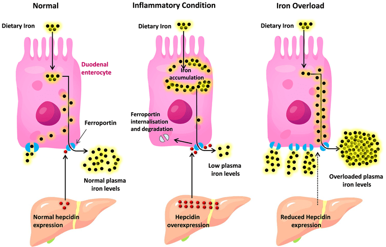 A Novel Approach for Iron Deficiency Anaemia with Liposomal Iron