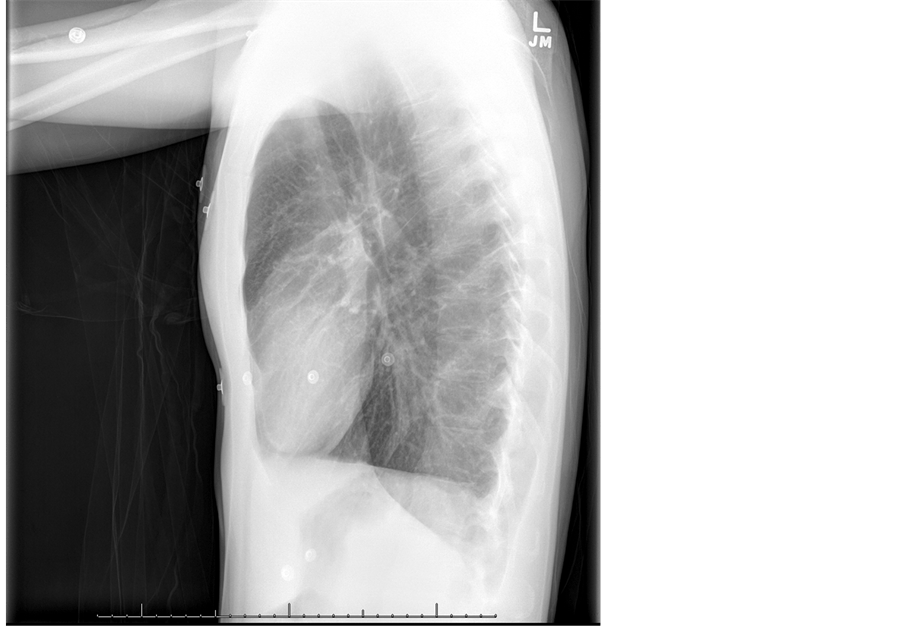 A Rare Cause of Chest Pain Disseminated Elemental Mercury