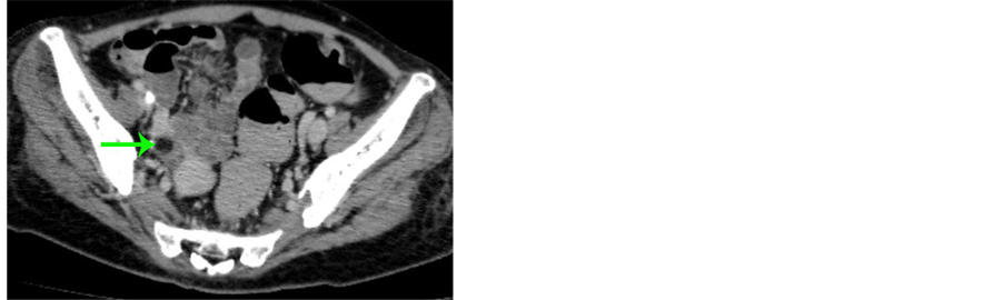 Anti NMethylDAspartate (NMDA) Receptor Encephalitis with Frustrated