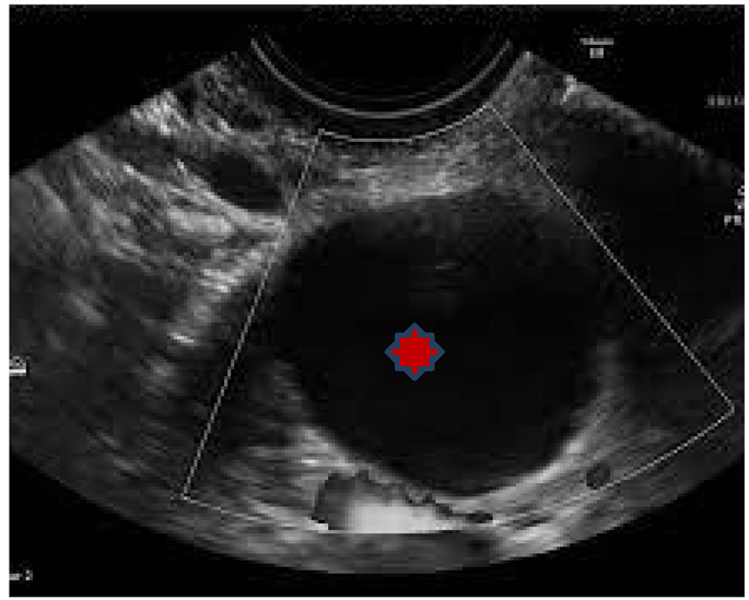 Place of Doppler Ultrasound in the Characterization of Ovarian Cysts