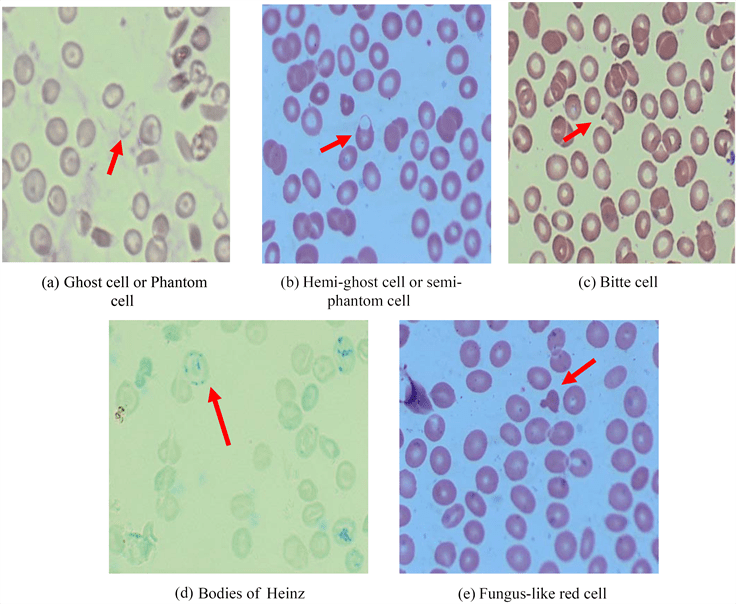 Glucose6Phosphate Dehydrogenase Deficiency Difficulties in Diagnosis