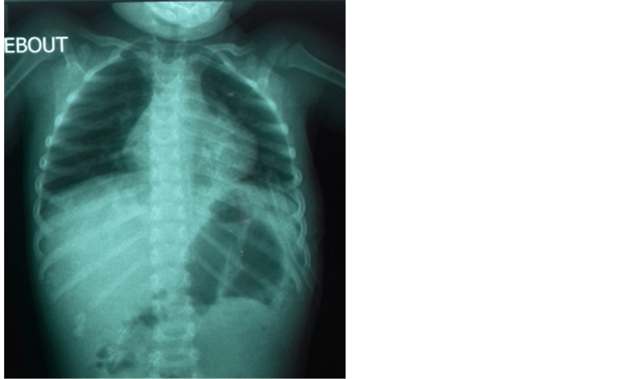 Secondary Spontaneous Rupture of the Diaphragm in a Child after Blunt