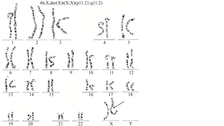 A New Case of Turner Syndrome with Early Pubertal Development