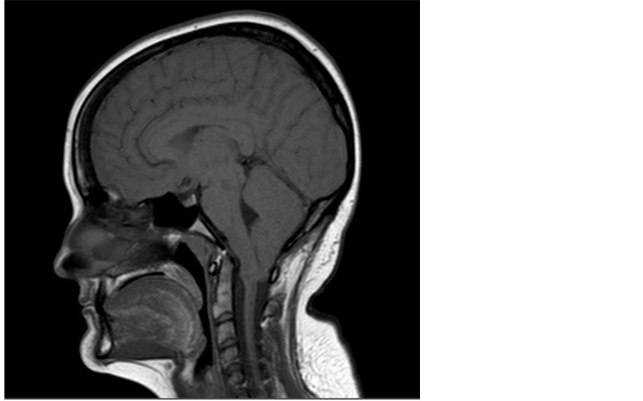 A Successful Pregnancy after Surgical of Type I