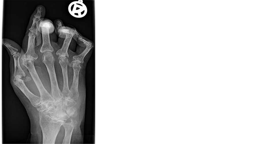Ocular Manifestations in Rheumatoid Arthritis