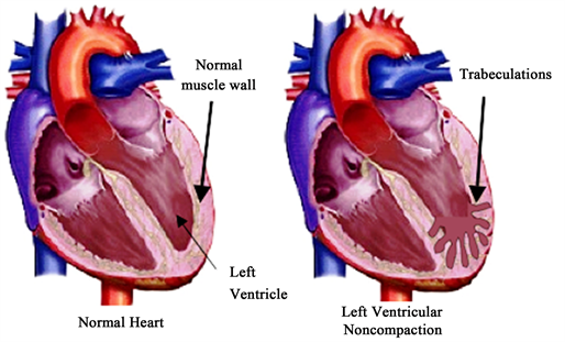 A Case Report of Isolated Left Ventricular Presenting