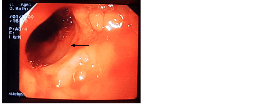 Ulcerative Colitis in Infant A Case Report at the University Hospital