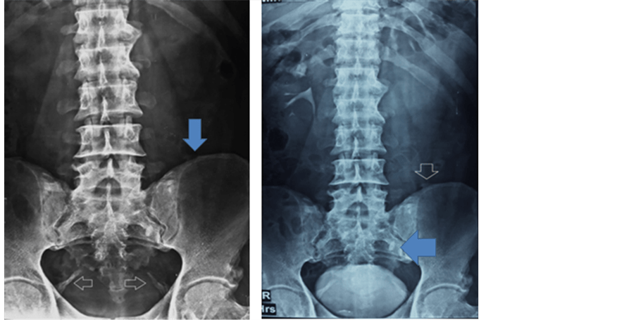 General Radiography as Clue for the Working Diagnosis Sacrospinous