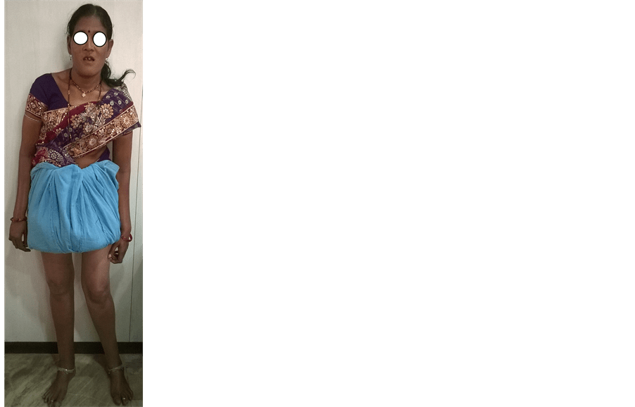 Fracture Femur in a Case of Pyle’s Disease A Case Report