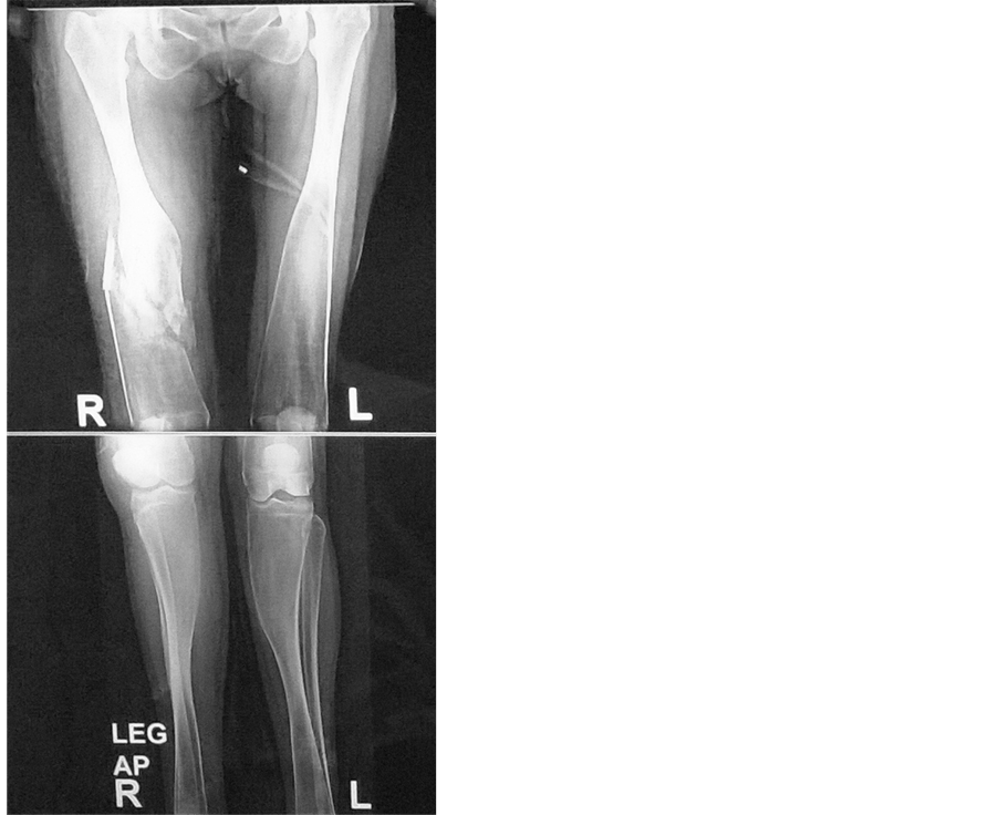 Fracture Femur in a Case of Pyle’s Disease A Case Report