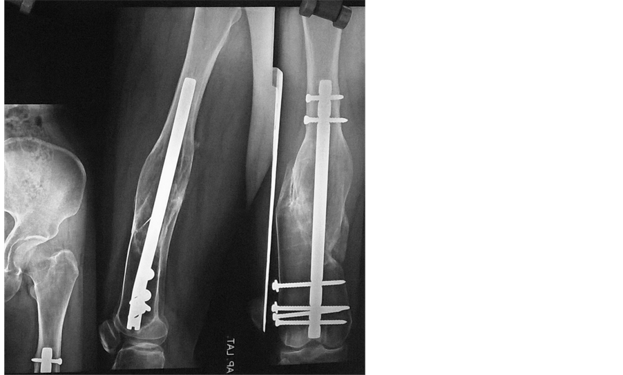Fracture Femur in a Case of Pyle’s Disease A Case Report