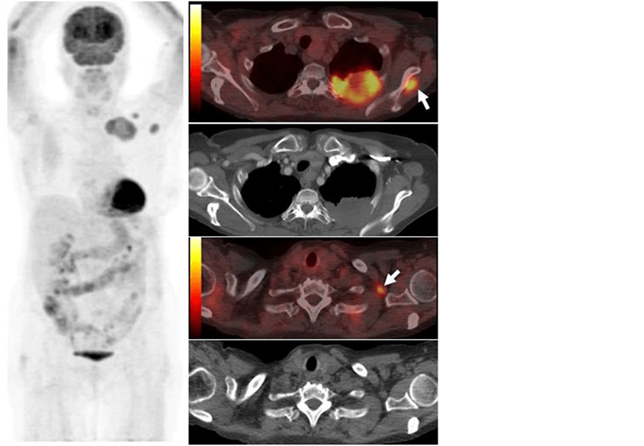 The Role of PET/CT Imaging in Lung Cancer